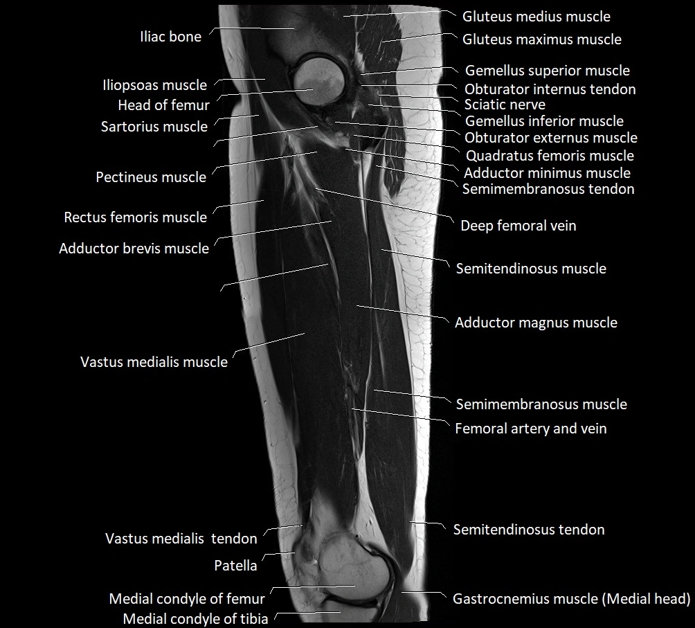 Thigh sagittal cross sectional anatomy MRI 3T image 12.webp